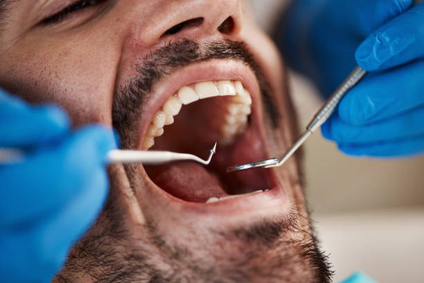 Best Knocked-Out Tooth (Avulsed Tooth) Treatment in Bowling Green, VA